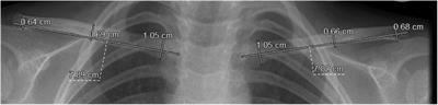 Defining clavicle growth in infancy using chest radiographs